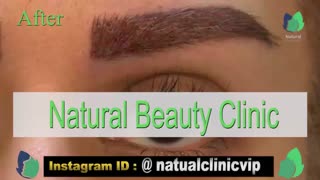 نمونه کار کاشت ابرو- قبل و بعد از کاشت !!!- نچرال بیوتی