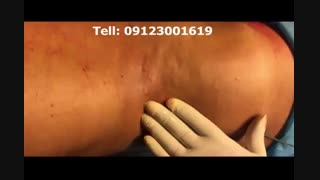 لیپوماتیک - دکتر ابدالی - 22807060 کاشت مو