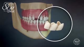 پروتز های دندانی (جایگزین دندان) | دندانپزشکی سیمادنت