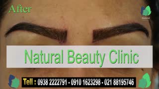 نمونه کار کاشت ابرو- قبل و بعد از کاشت !!!- نچرال بیوتی