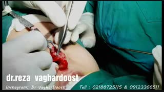 فیلم عمل زیبایی بینی (دکتر رضا وقردوست)( پارت 1)