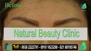نمونه کار کاشت ابرو- قبل و بعد از کاشت !!!- نچرال بیوتی