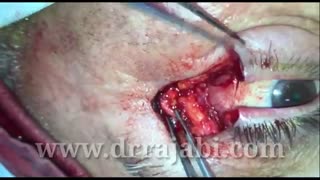 تومور BCC کانتوس یا گوشه خارجی پلک پایین و بالا