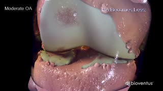 مراحل ساییدگی مفصل زانو و بروز علائم آرتروز