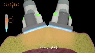 اسکالپشور sculpsure