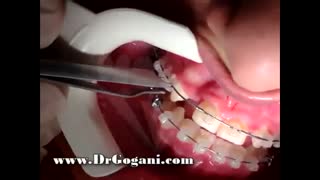 مراحل ارتودنسی - جا انداختن سیم در سیسستم سلف لیگیت همرنگ دندان (دیمون شفاف)