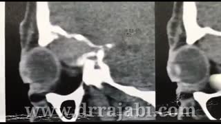 تومور بزرگ کاسه چشم با درگیری استخوان و گسترش به مغز