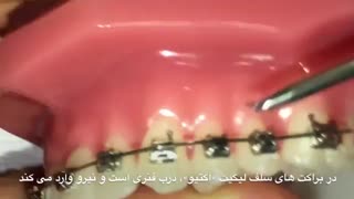 انواع ارتودنسی ثابت - مقایسه سلف لایگیتینگ ها با هم و با انواع قدیمی تر