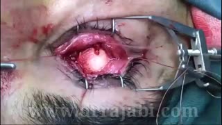 کارگذاری پروتز هیدروکسی اپاتیت پس از تخلیه چشم