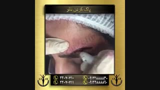 پاک کردن تاتو در  آذر کلینیک