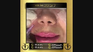 از بین رفتن خط خنده - آذر کلینیک