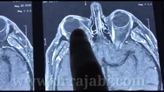 جراحی تومور بزرگ کاسه چشم با چسبندگی به عصب بینایی