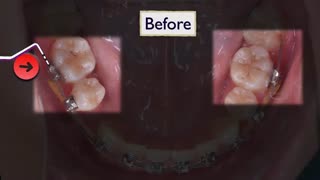 ایمپلنت دندان-مراحل ایمپلنت دندان