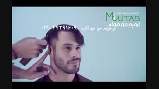 کاشت مو بدون جراحی 02144291609