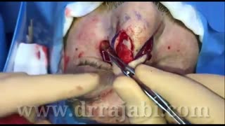 جراحی تومور وسیع و عودکننده پل بینی و کانتوس داخلی