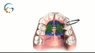 دستگاه پندولوم ارتودنسی | دکتر مسعود داوودیان