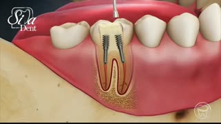 پست و کور دندان | دندانپزشکی سیمادنت