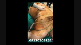 لیپوماتیک - دکتر ابدالی - 22807060 درمان جای جوش