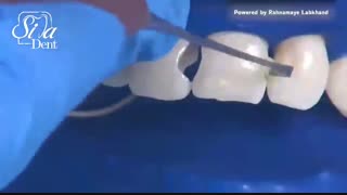 کامپوزیت ونیر | دندانپزشکی سیمادنت