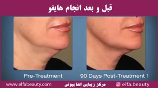قبل و بعد انجام هایفو یا هایفو تراپی