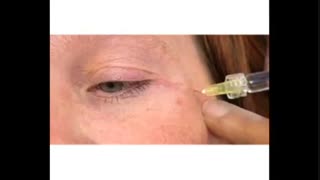 تزریق فیلر برای جوانسازی صورت رفع افتادگی پلک