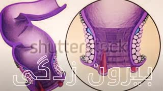 درمان میشه بدون جراحی www.castelinagold.com