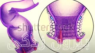 درمان میشه بدون جراحی www.castelinagold.com