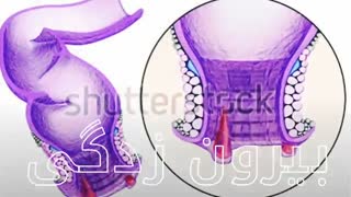 درمان میشه بدون جراحی www.castelinagold.com