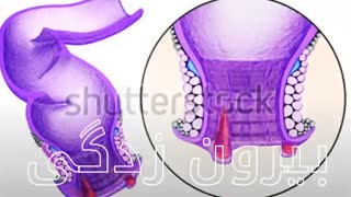 درمان میشه بدون جراحی www.castelinagold.com