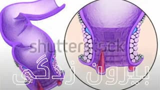 درمان میشه بدون جراحی www.castelinagold.com