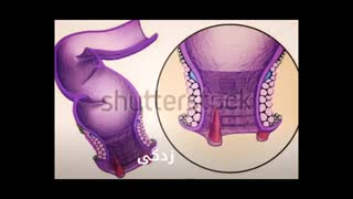 درمان میشه بدون جراحی www.castelinagold.com