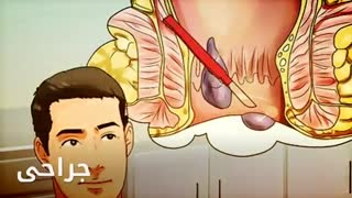 درمان میشه بدون جراحی www.castelinagold.com