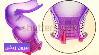 درمان قطعی خونریزی مقعد www.castelinagold.com