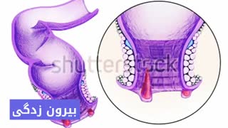 درمان قطعی خونریزی مقعد www.castelinagold.com