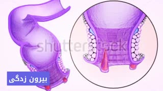 درمان قطعی خونریزی مقعد www.castelinagold.com