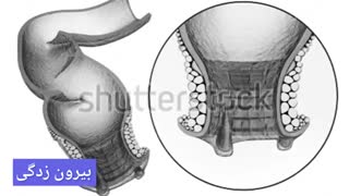 درمان قطعی خونریزی مقعد www.castelinagold.com