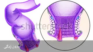 درمان قطعی خونریزی مقعد www.castelinagold.com