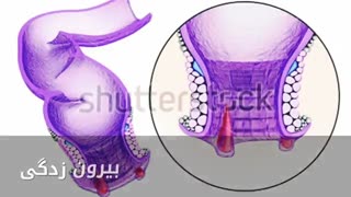 درمان قطعی خونریزی مقعد www.castelinagold.com