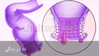 درمان قطعی خونریزی مقعد www.castelinagold.com