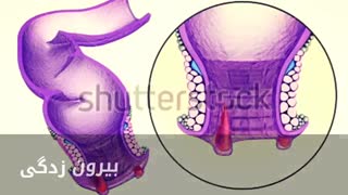 درمان قطعی خونریزی مقعد www.castelinagold.com