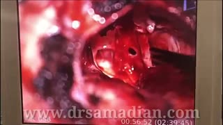 حفظ عصب شنوایی و صورت در تومور شوانوم عصب 8