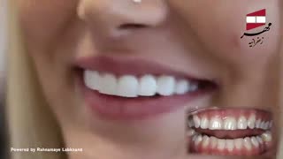 لمینیت کامپوزیتی | کلینیک دندانپزشکی مهر زعفرانیه