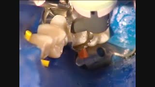 جایگزینی ترمیم آمالگام با  کامپوزیت Tetric N-Ceram کمپانی Ivoclar Vivadent