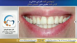 قبل و بعد ارتودنسی بدون کشیدن دندان | دکتر داوودیان