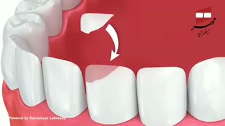 کلینیک تخصصی مهر زعفرانیه - لمینیت کامپوزیتی
