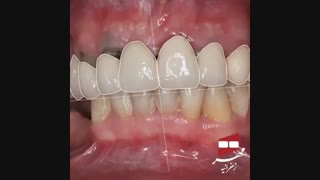 قبل و بعد درمان و اصلاح طرح لبخند | کلینیک دندانپزشکی مهر زعفرانیه