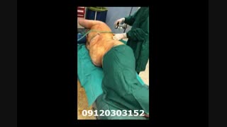 لیپوماتیک - دکتر ابدالی - 22807060 درمان ریزش مو