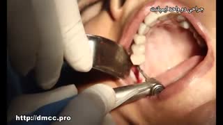 ویدئو کاشت ایمپلنت | کلینیک دندانپزشکی مدرن