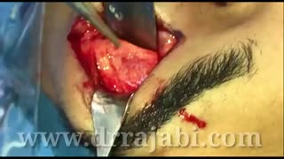 بازسازی لبه فوقانی کاسه چشم و پیشانی