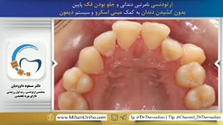 قبل و بعد ارتودنسی بدون  کشیدن دندان | دکتر داوودیان